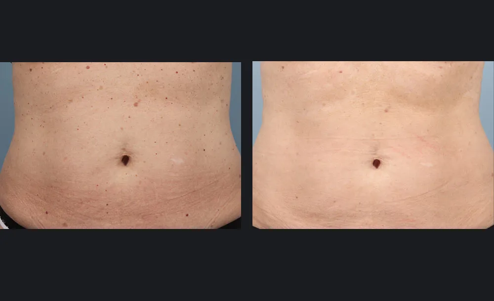 Αποτελέσματα πριν και μετά την αποτρίχωση laser