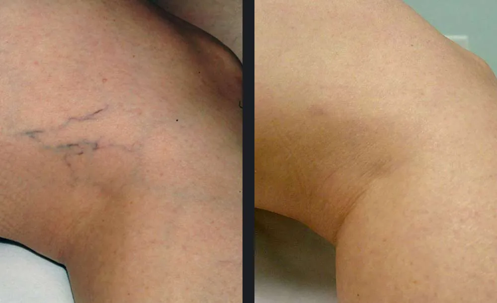 Αποτελέσματα πριν και μετά την αποτρίχωση laser