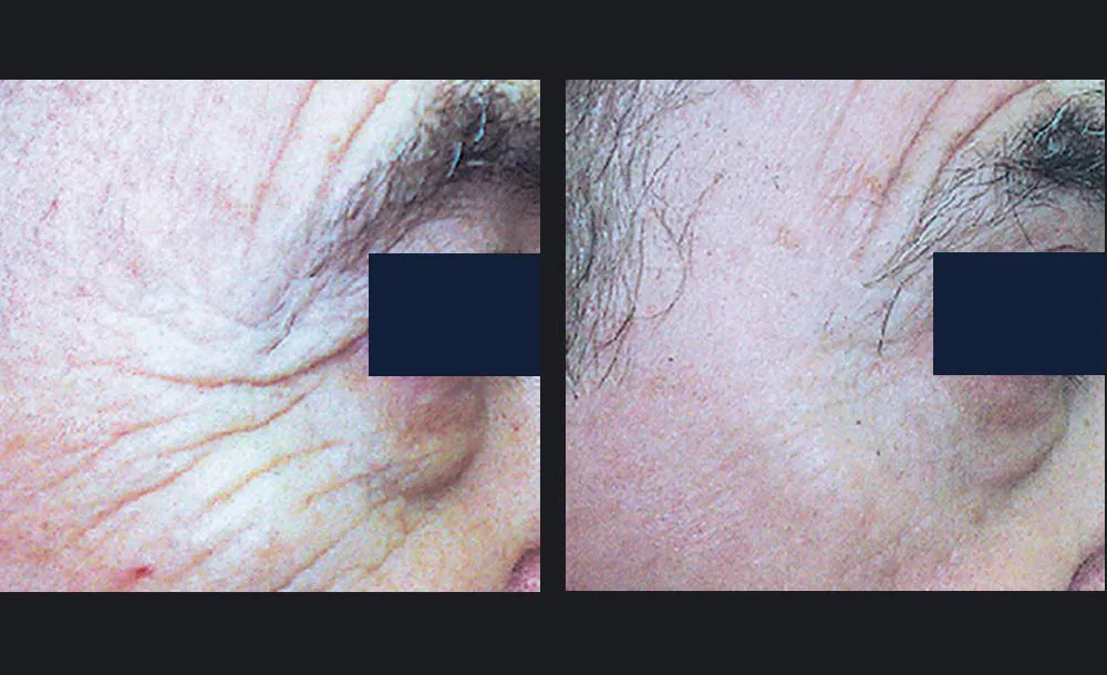 Αποτελέσματα πριν και μετά την αποτρίχωση laser