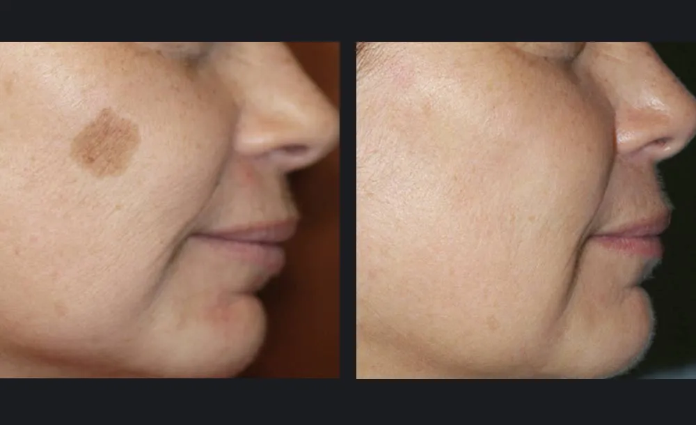 Αποτελέσματα πριν και μετά την αποτρίχωση laser